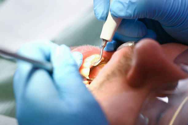 Best Emergency Tooth Extraction in Pukalani, HI