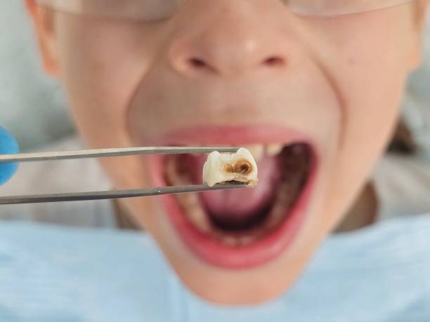 Best Emergency Tooth Extraction in Pukalani, HI